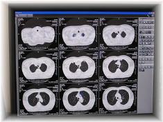 低線量肺がんCT検査は簡単で早く安全性が高い